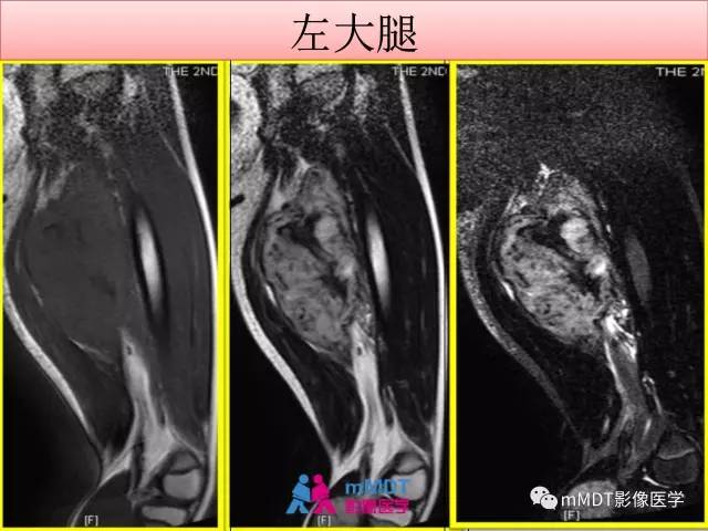 【PPT】韧带样纤维瘤病的影像分析