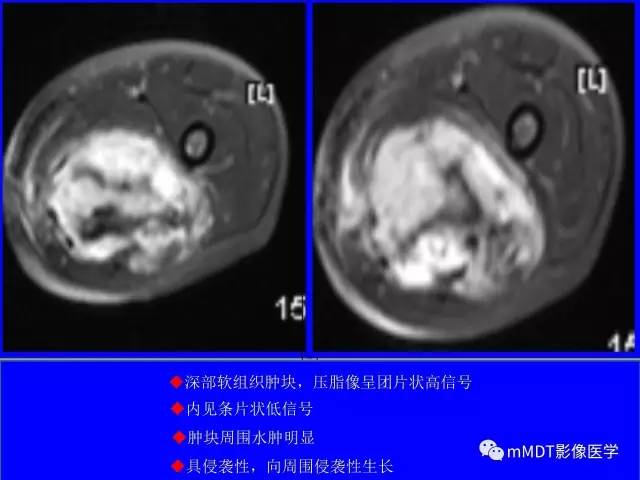 【PPT】韧带样纤维瘤病的影像分析