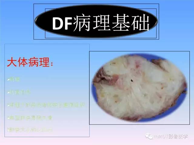 【PPT】韧带样纤维瘤病的影像分析