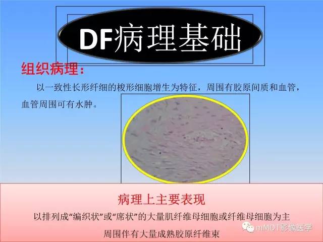 【PPT】韧带样纤维瘤病的影像分析
