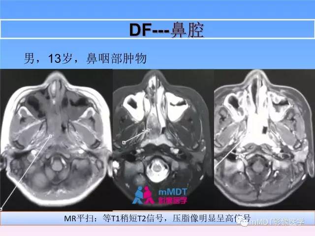 【PPT】韧带样纤维瘤病的影像分析