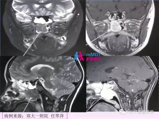 【PPT】韧带样纤维瘤病的影像分析