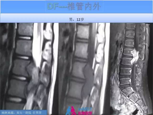 【PPT】韧带样纤维瘤病的影像分析