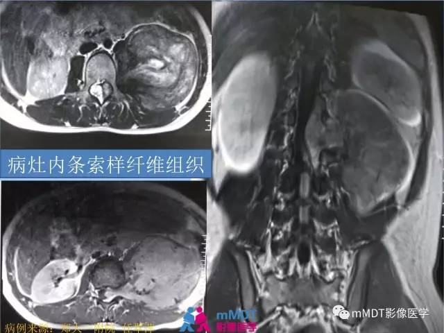 【PPT】韧带样纤维瘤病的影像分析