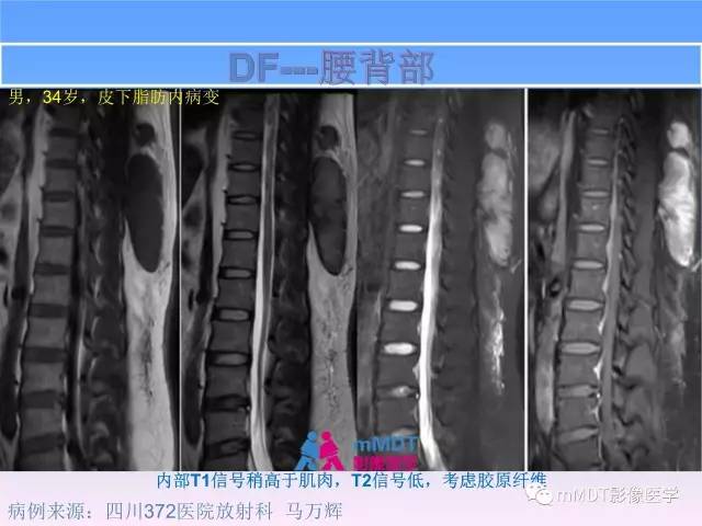 【PPT】韧带样纤维瘤病的影像分析