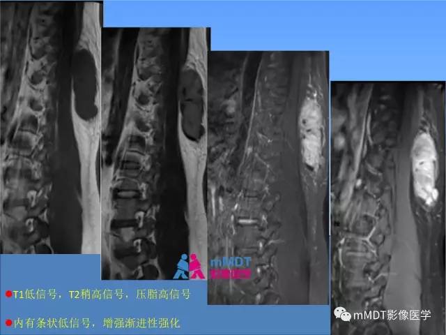 【PPT】韧带样纤维瘤病的影像分析