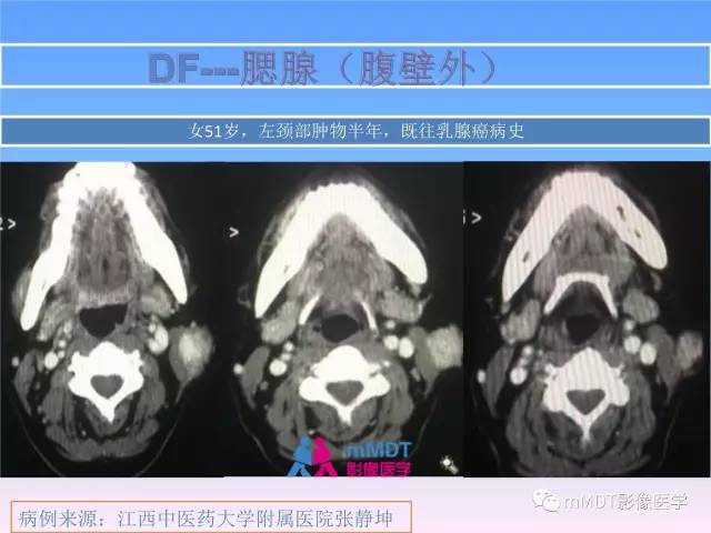 【PPT】韧带样纤维瘤病的影像分析