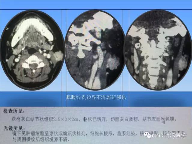 【PPT】韧带样纤维瘤病的影像分析