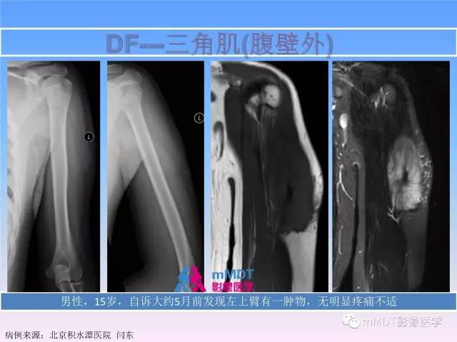 【PPT】韧带样纤维瘤病的影像分析