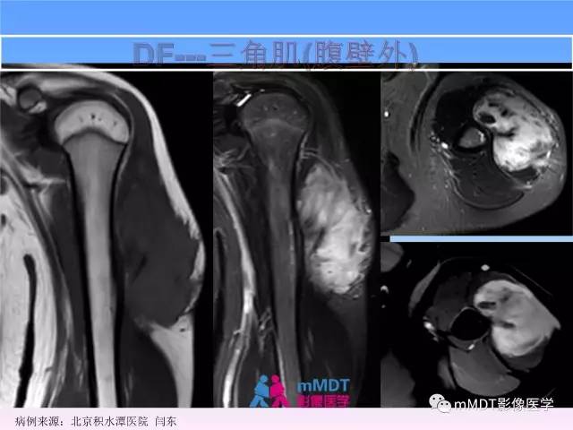 【PPT】韧带样纤维瘤病的影像分析