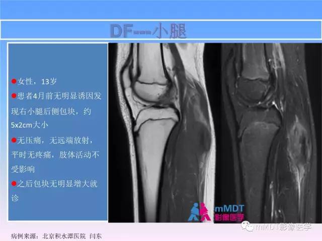 【PPT】韧带样纤维瘤病的影像分析