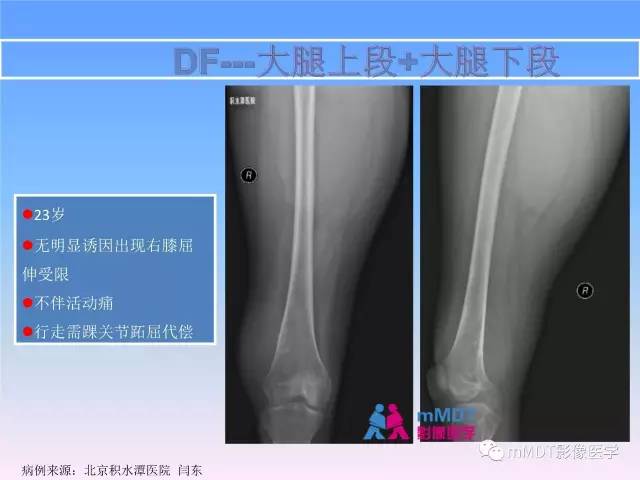 【PPT】韧带样纤维瘤病的影像分析