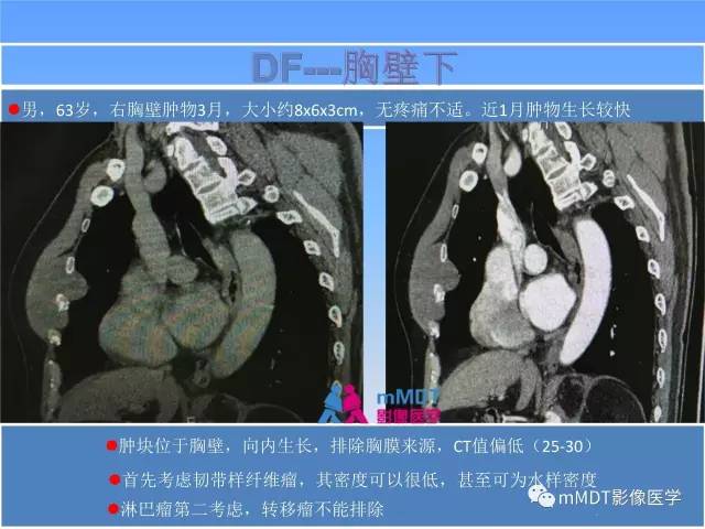 【PPT】韧带样纤维瘤病的影像分析