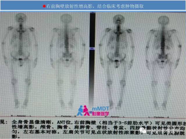【PPT】韧带样纤维瘤病的影像分析