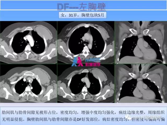 【PPT】韧带样纤维瘤病的影像分析