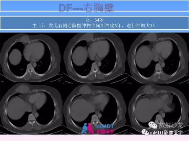 【PPT】韧带样纤维瘤病的影像分析