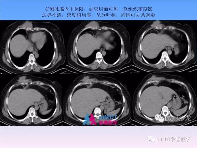 【PPT】韧带样纤维瘤病的影像分析