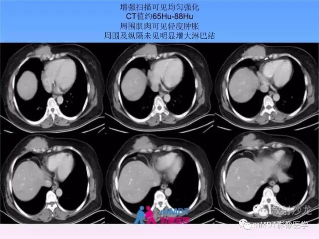 【PPT】韧带样纤维瘤病的影像分析