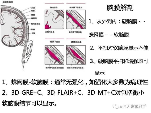 【PPT】脑膜肥厚性病变的影像诊断