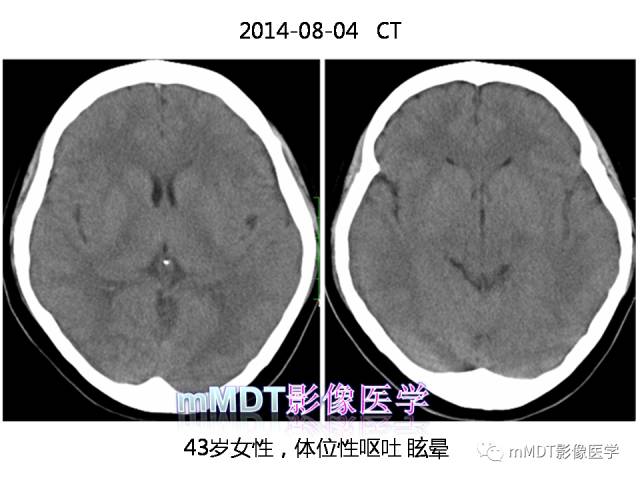 【PPT】脑膜肥厚性病变的影像诊断