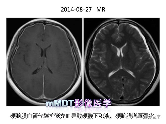【PPT】脑膜肥厚性病变的影像诊断