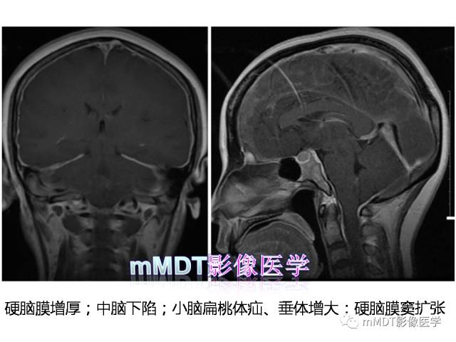 【PPT】脑膜肥厚性病变的影像诊断