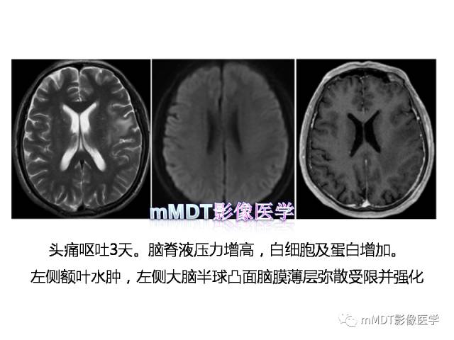【PPT】脑膜肥厚性病变的影像诊断