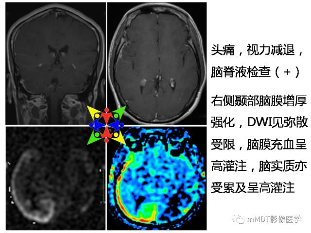 【PPT】脑膜肥厚性病变的影像诊断