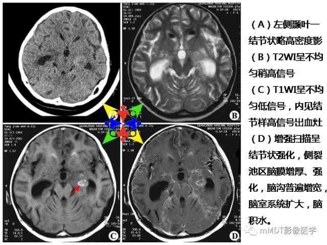 【PPT】脑膜肥厚性病变的影像诊断