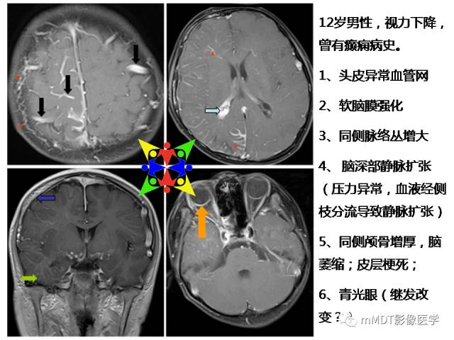 【PPT】脑膜肥厚性病变的影像诊断