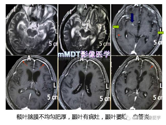 【PPT】脑膜肥厚性病变的影像诊断
