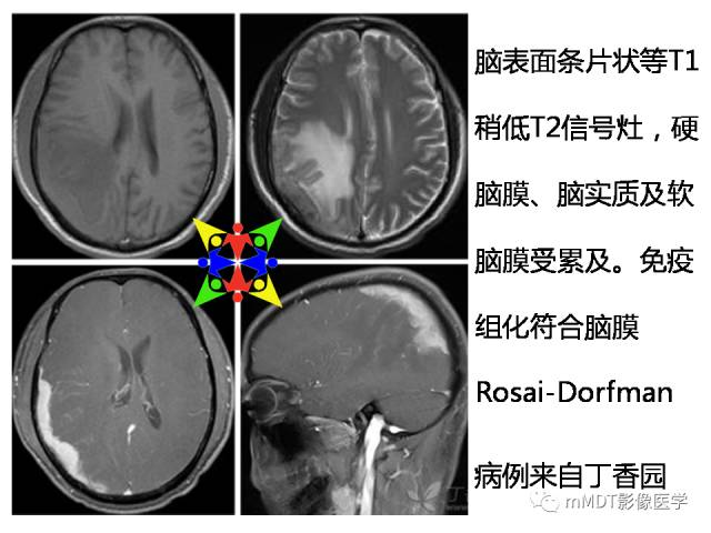【PPT】脑膜肥厚性病变的影像诊断