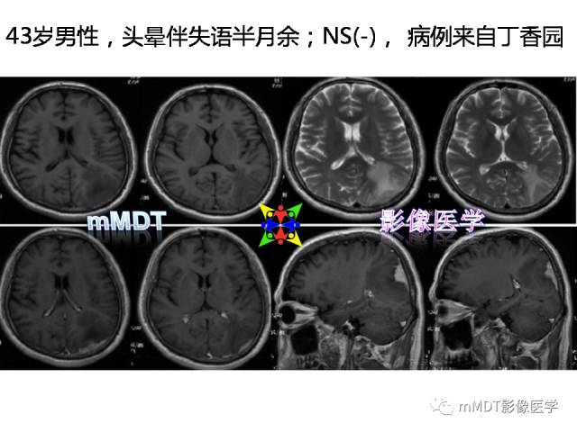 【PPT】脑膜肥厚性病变的影像诊断