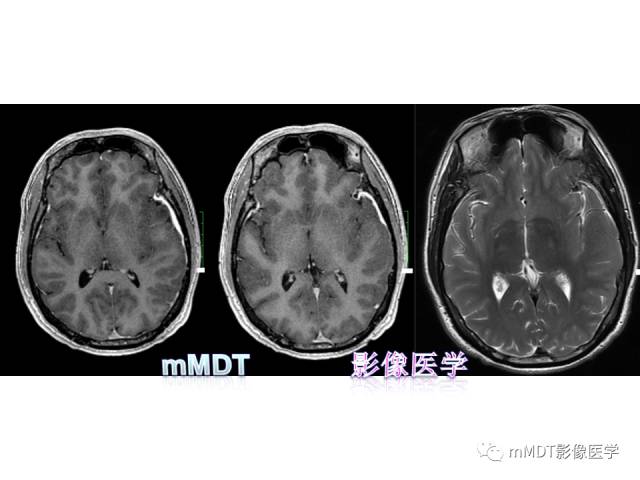 【PPT】脑膜肥厚性病变的影像诊断