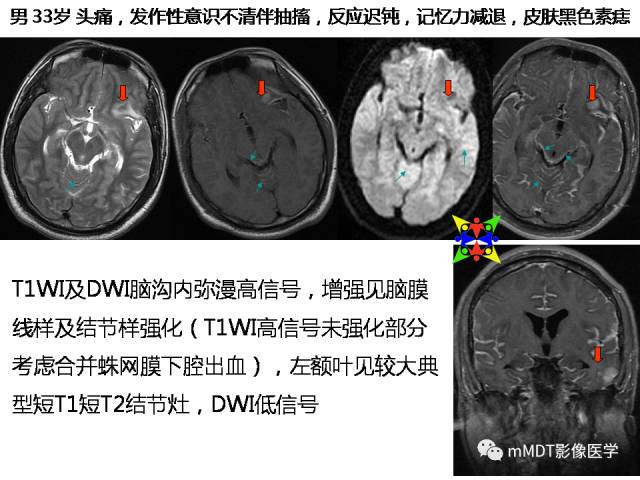 【PPT】脑膜肥厚性病变的影像诊断