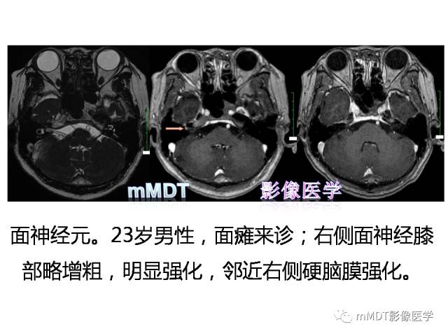 【PPT】脑膜肥厚性病变的影像诊断