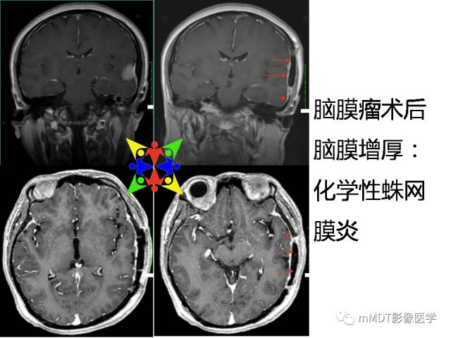 【PPT】脑膜肥厚性病变的影像诊断