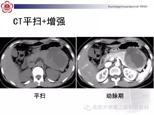 【病例】胰腺实性假乳头状瘤1例CT影像表现