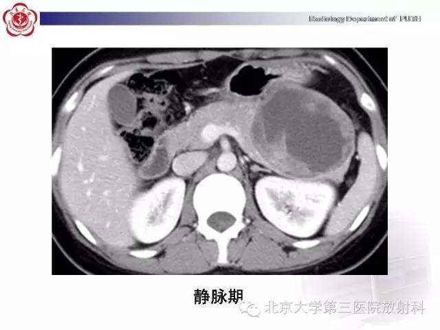 【病例】胰腺实性假乳头状瘤1例CT影像表现
