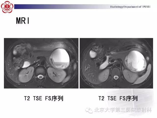 【病例】胰腺实性假乳头状瘤1例CT影像表现