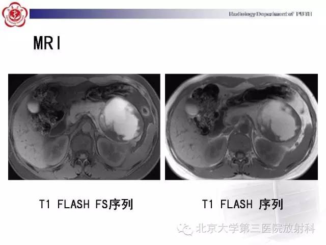 【病例】胰腺实性假乳头状瘤1例CT影像表现