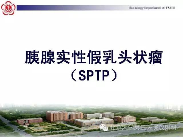 【病例】胰腺实性假乳头状瘤1例CT影像表现