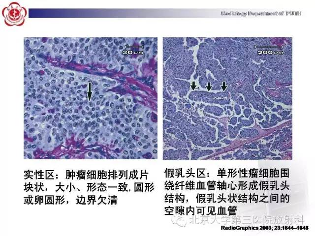 【病例】胰腺实性假乳头状瘤1例CT影像表现