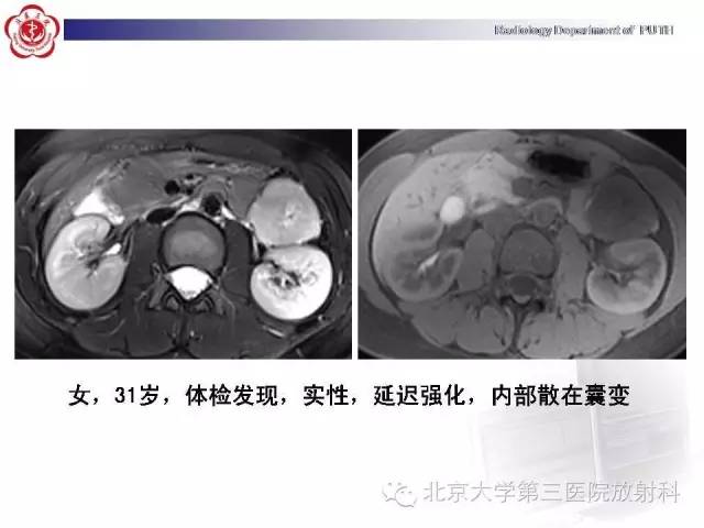 【病例】胰腺实性假乳头状瘤1例CT影像表现