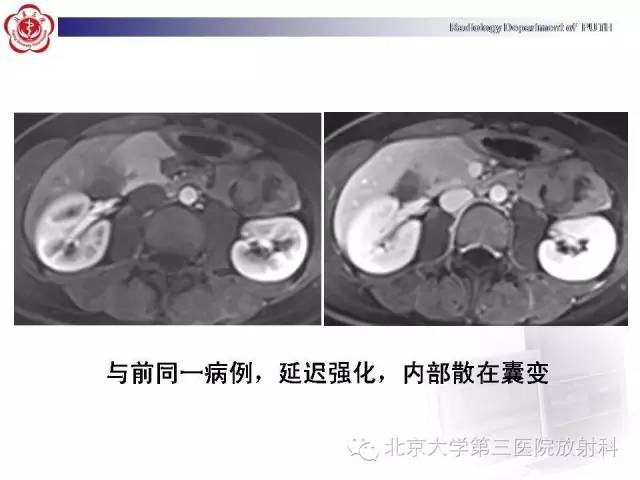【病例】胰腺实性假乳头状瘤1例CT影像表现
