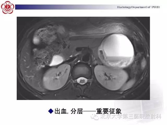 【病例】胰腺实性假乳头状瘤1例CT影像表现