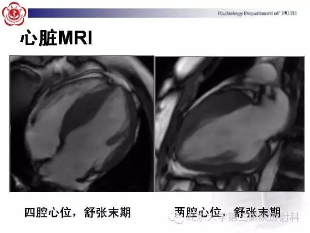 【病例】肥厚性心肌病1例MR影像表现
