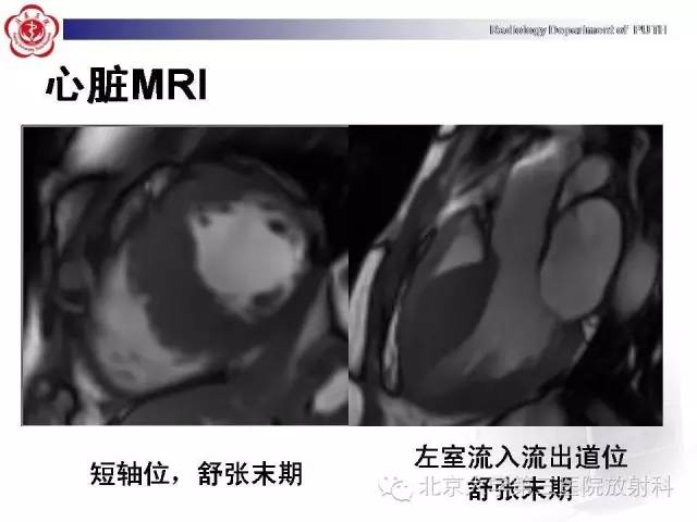 【病例】肥厚性心肌病1例MR影像表现