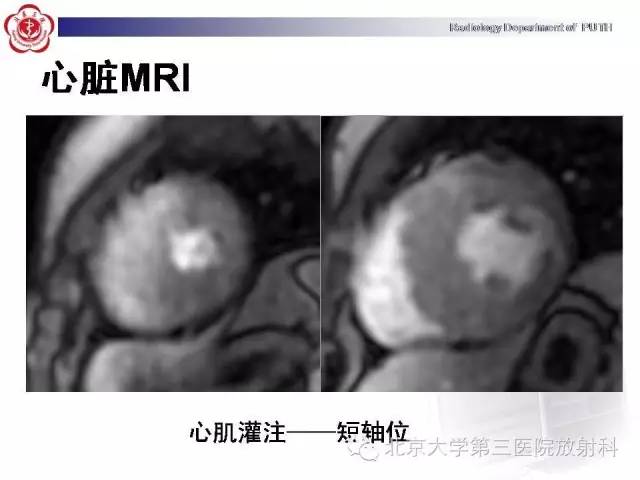 【病例】肥厚性心肌病1例MR影像表现