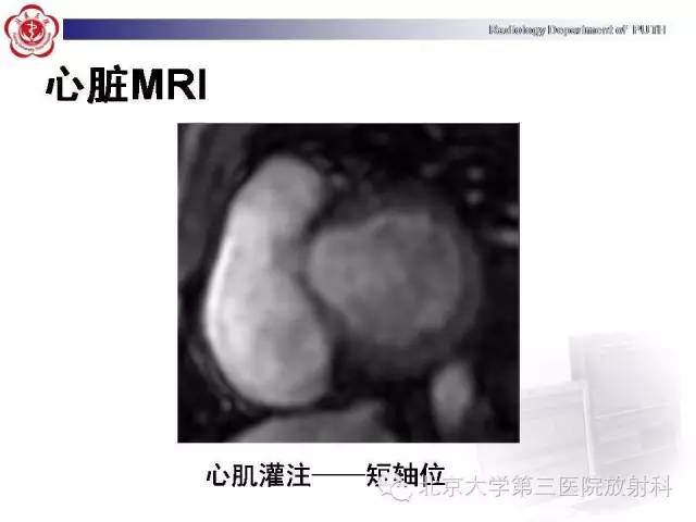 【病例】肥厚性心肌病1例MR影像表现